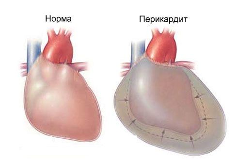 เยื่อหุ้มหัวใจอักเสบเฉียบพลันและปวดทรวงอกด้านซ้าย