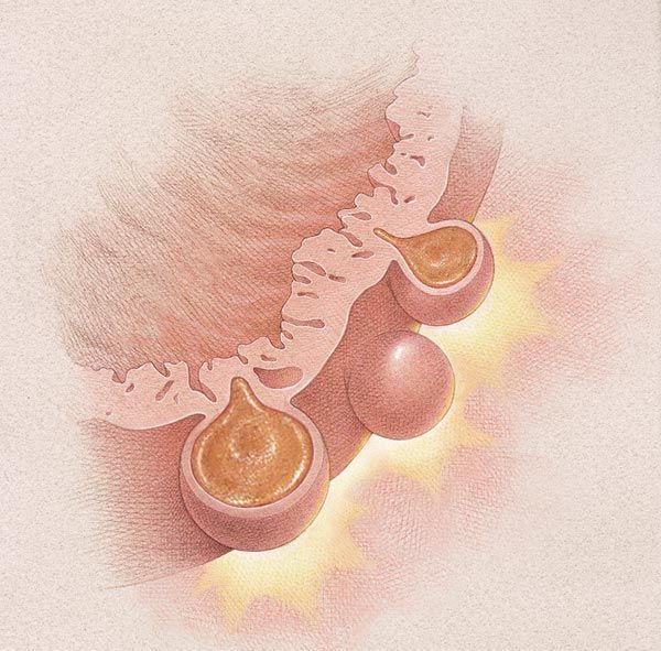 Diverticulosis ของลำไส้