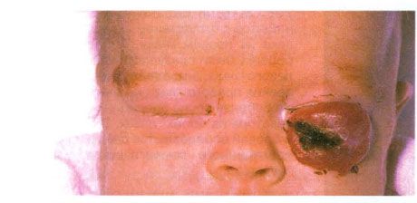 <u><em><u><em><em>Hemangioma ของเปลือกตาล่าง</em></em></u></em></u>. 