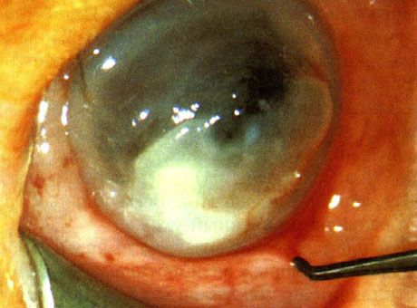 Keratitis ที่เกิดจาก Pseudomonas ในเด็กแรกเกิด  ไม่ได้มีการระบุปัจจัย predisposing