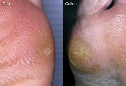 Hemorrhages และ calluses