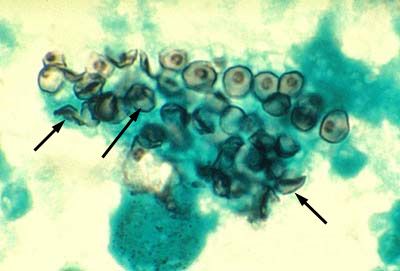 สาเหตุของ pneumocystis (Pneumocystis jiroveci)