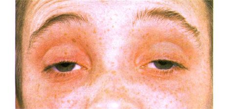 ภายนอกจักษุวิทยา  ptosis สองด้าน  ผู้ป่วยเปิดตาด้วยการยกคิ้วขึ้น