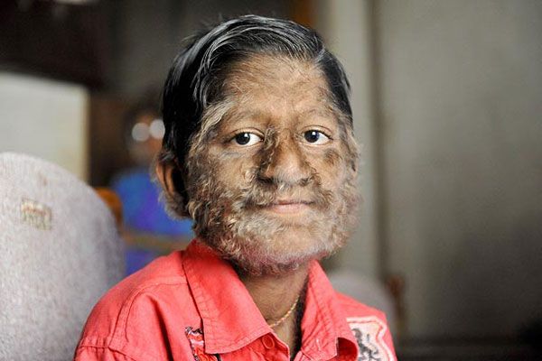 Werewolf Syndrome