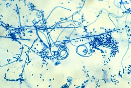 สาเหตุของ epidermophytosis ของเท้า (Trichophyton interdigitale)